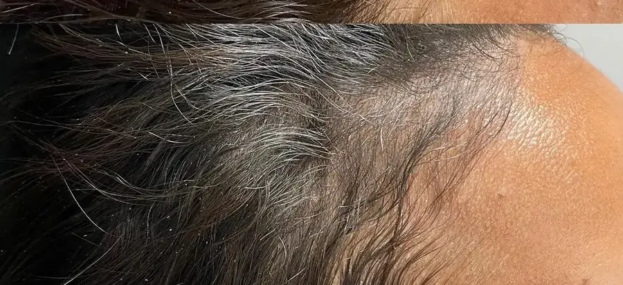 After Procell hair restoration progress at Skin9 Studio, Oakville
