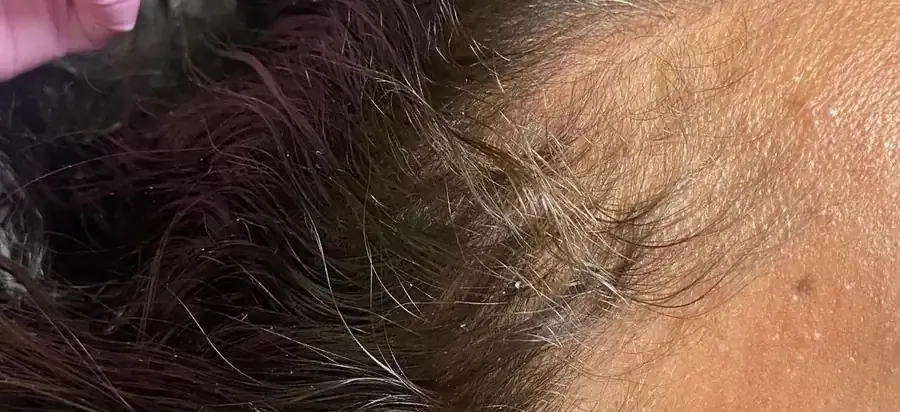 Before Procell hair restoration progress at Skin9 Studio, Oakville