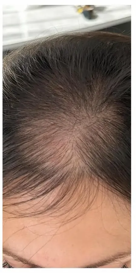 After Procell hair restoration result at Skin9 Studio, Oakville