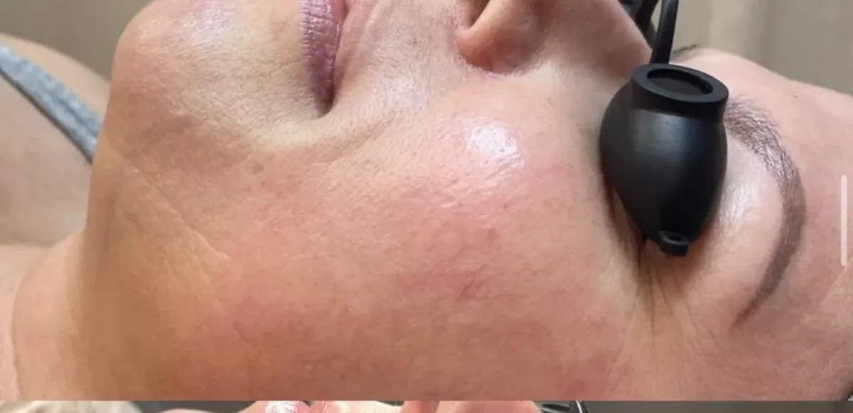 Before Procell microchanneling at Skin9 Studio, Oakville