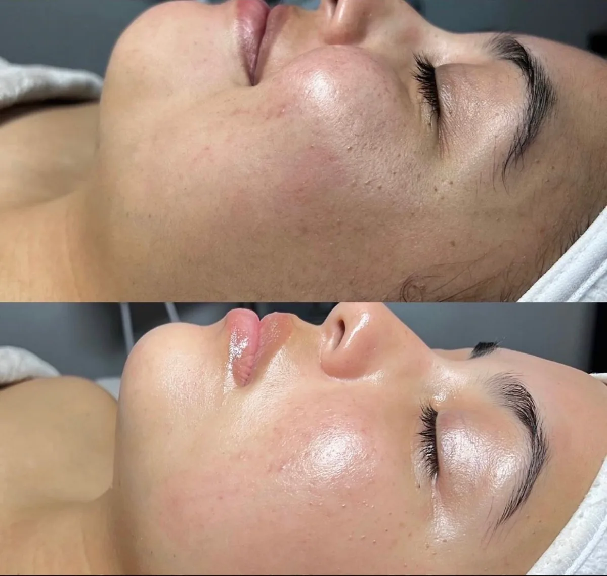 Before and after a course of treatment at Skin9 Studio in Oakville